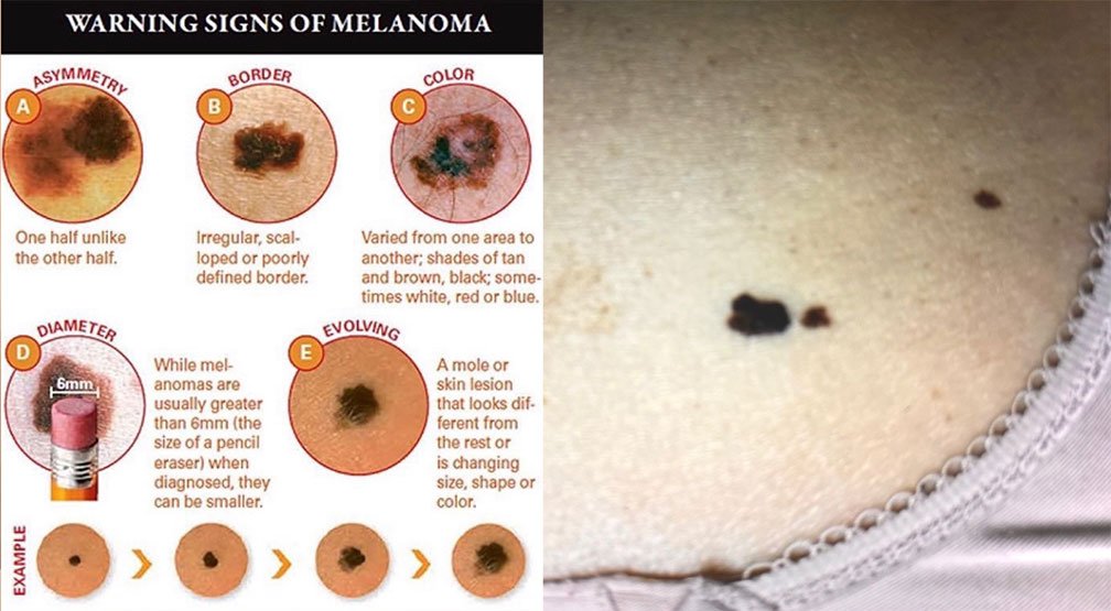 Skin cancer